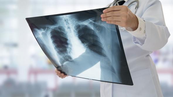 Bildergebnis fÃ¼r wie die LungenentzÃ¼ndung, kostenlosen bilder